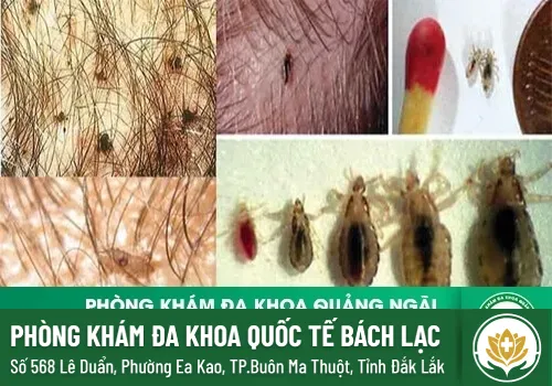 Ngứa dương vật là bệnh gì?